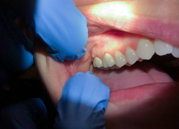 Best Emergency Dentist for Knocked-Out Tooth in Newburyport, MA